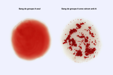 Réaction d'agglutination d'hématies A avec sérum anti-A